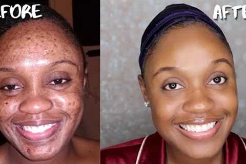 AFFORDABLE SKIN CARE ROUTINE FOR ACNE, DARK MARKS, AND HYPERPIGMENTATION