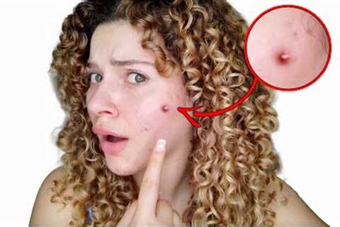 ARE YOUR CURLY HAIR PRODUCTS CAUSING ACNE? (causes, symptoms and solutions)