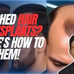 Hair Restoration Surgeon Reveals How to Fix Botched Hair Transplants | Expert Tips & Solutions..